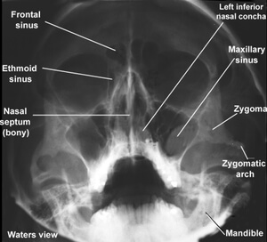 Sinus-X-Ray