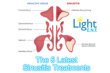 5-Latest-Sinusitis-Treatment