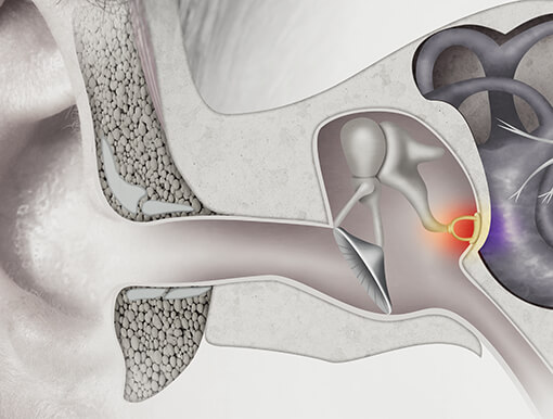 Otosclerosis Hearing Loss  Stapedectomy Surgery Boynton Beach, FL