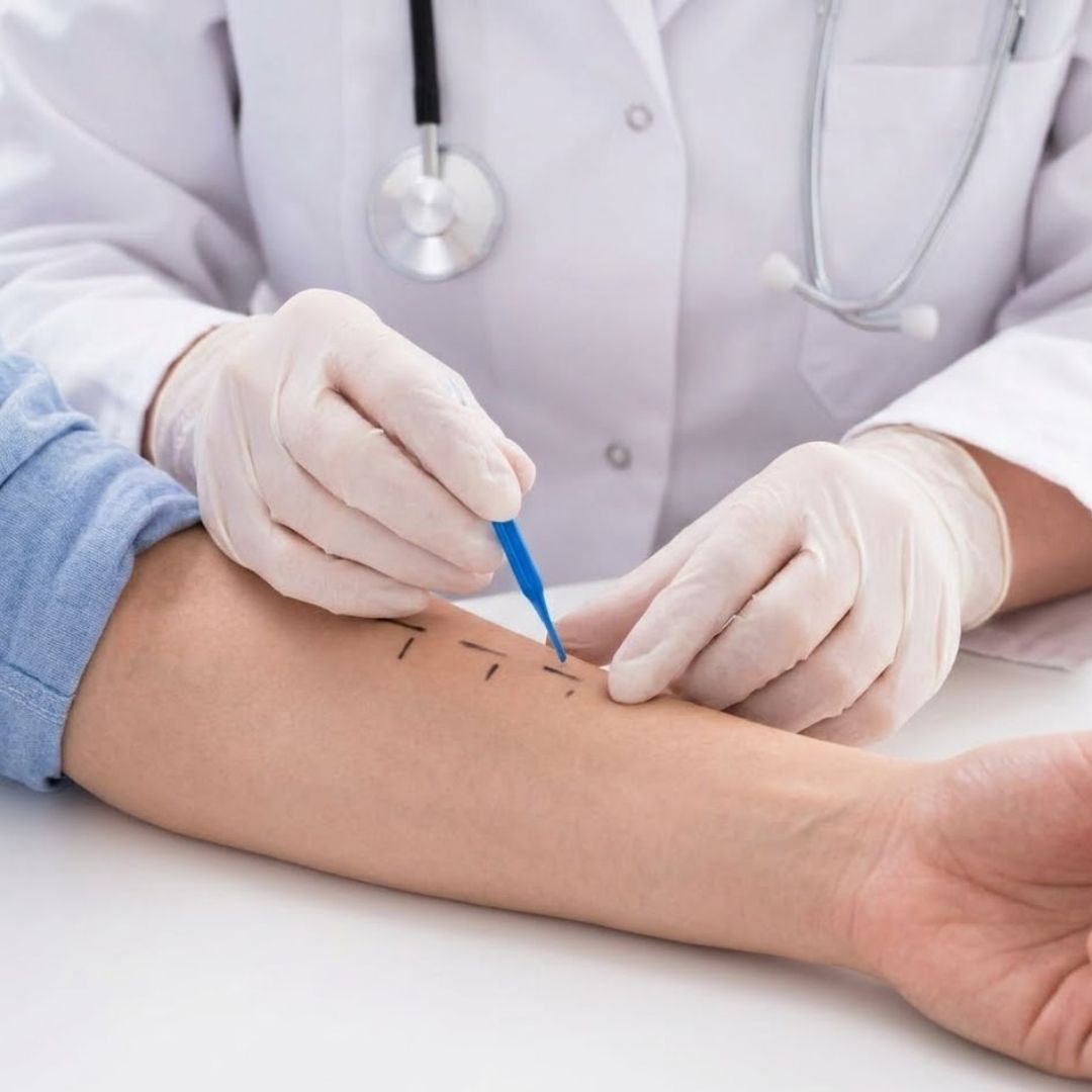 A healthcare provider performs an allergy skin prick test on a patient's forearm.